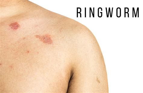 Understanding Ringworm Causes Symptoms And Treatment Maxinhealth