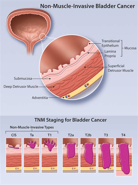 Non Muscle Invasive Bladder Cancer Review Of Diagnosis And Management Healthplexus Net