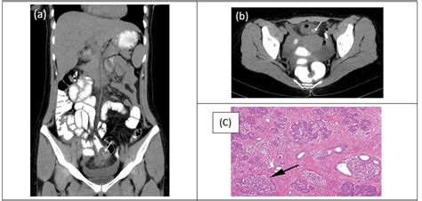 Preoperative Computed Tomography Ct Images Coronal A And