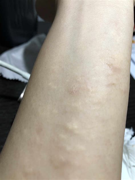 how do i get rid of bumps under the skin at my forearm area photo human