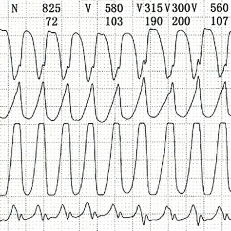 Findings From The Electrophysiological Test Ventricular Tachycardia