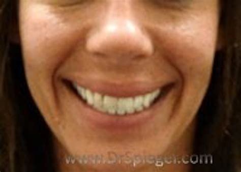 Dimpleplasty Boston Dimple Plastic Surgery Ma