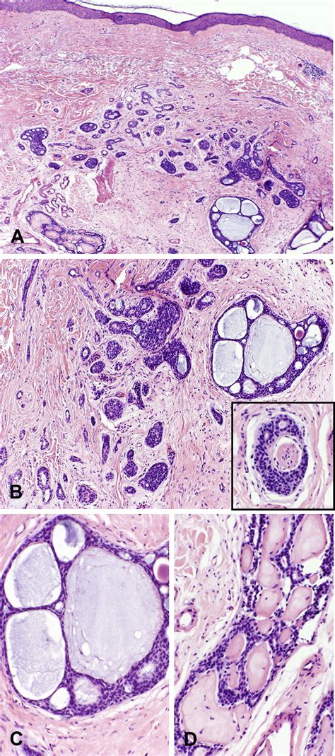 Primary Cutaneous Adenoid Cystic Carcinoma Journal Of The American