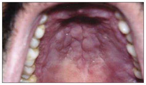Diagnosis Oral Leishmaniasis Annals Of Saudi Medicine