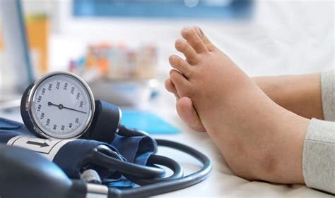 High Blood Pressure Swollen Ankles Is Oedema And Means You Need To