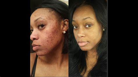 My Acne Story And Accutane Journey Before And After No