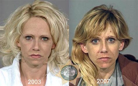 Before the mesotherapy application, a physical examination is performed first. Faces of Meth (22 pics)