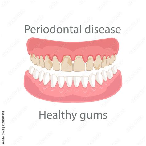 Dental Concept Gum Treatment Gum Disease And Teeth Periodontal