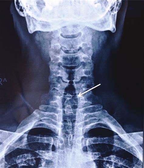 Double Spinous Process Sign In The Ap Cervical X Ray Download