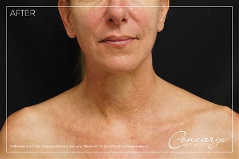 Before And After Photos Laser Ipl And Genesis Concierge Aesthetics