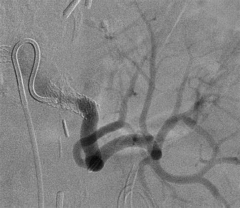 Renal Artery Stenosis Prevalence Of Risk Factors For And Management