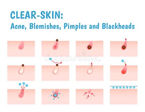 Types Of Acne And Pimples Stock Vector Illustration Of Gland 91655373