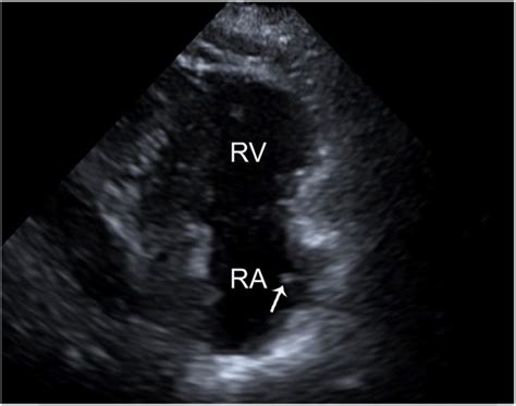 Right Ventricular Inflow View Shows The Membranelike Structure Arrow