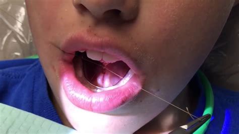 Functional Frenuloplasty Updated Technique With Lingual Palatal