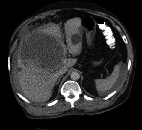 Haemorrhagic Rupture Of Hepatic Simple Cysts Bmj Case Reports
