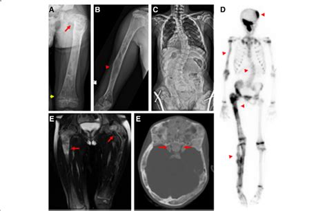 Representative Radiographic Features Of Fibrous Dysplasia A Femoral
