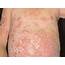 Pustular Psoriasis Causes Risk Factors Symptoms And Types