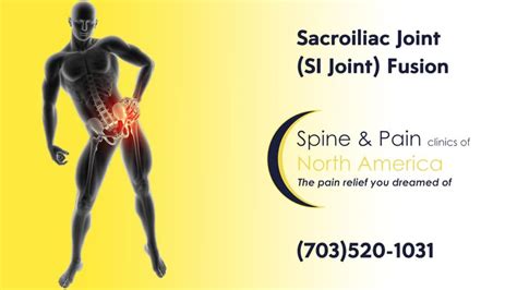 Sacroiliac Joint SI Joint Fusion At SAPNA Spine And Pain Clinic Of North America Fairfax And