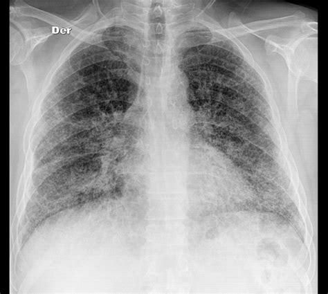 Interstitial Lung Disease X Ray