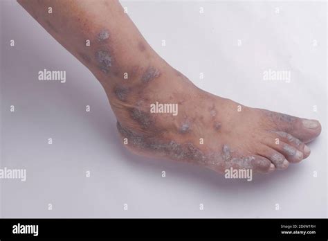 Psoriasis On The Foot Hi Res Stock Photography And Images Alamy