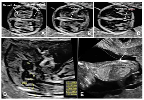 Brain Sciences Free Full Text First Trimester Ultrasound Detection Of Fetal Central Nervous