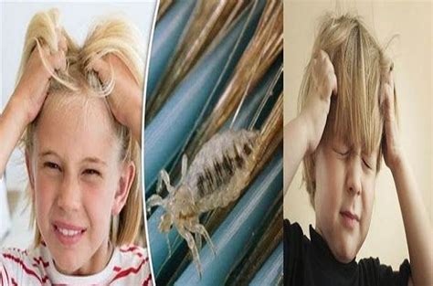 Head Lice Symptoms And Causes Home Remedies For Treating Head Lice