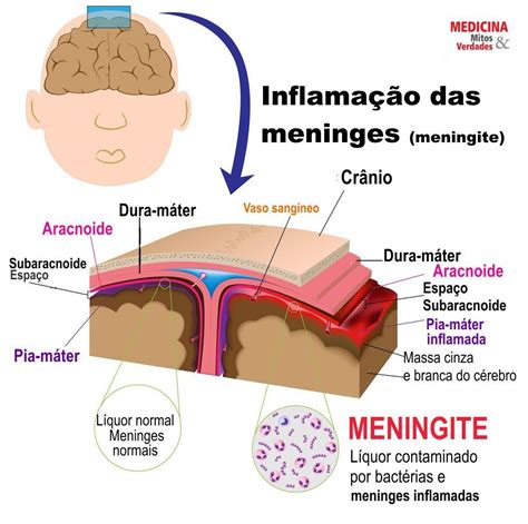 Meningite é a inflamação das meninges Exame fisico enfermagem