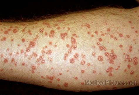 Guttate Psoriasis Pictures