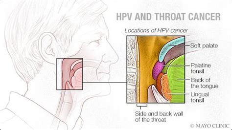 Mayo Clinic Q And A Increasing Incidence Of Throat Cancer Related To Hpv Mayo Clinic News Network