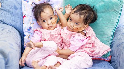 Separated conjoined twins remain close in Melbourne hospital