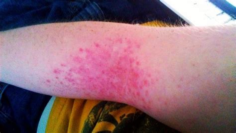 Strange Red Bumps On My Arm Prescription Acne Medications
