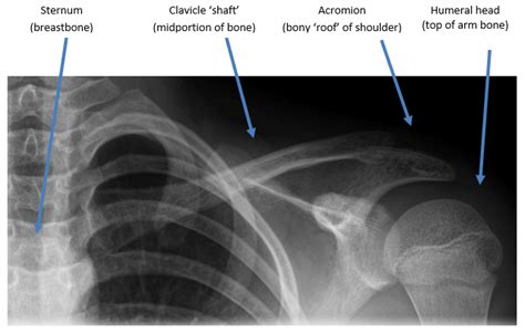Orthokids Clavicle Fractures