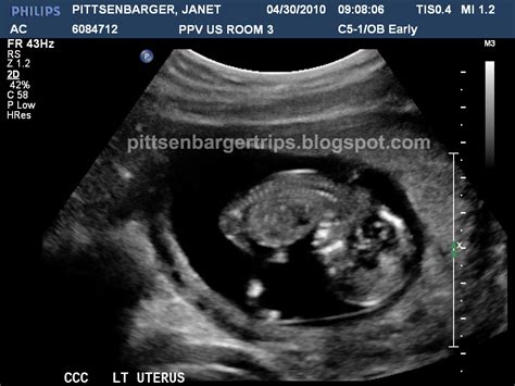 Pitts Trips The Pittsenbarger Identical Triplets Saga 12 Week Ultrasound