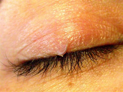 Ingrown Eyelash Treatment Home Remedies Removal Causes Symptoms