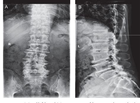 Lumbar Scoliosis X Ray