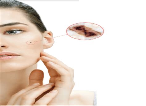 Non Invasive Skin Cancer Treatment Skin Cancer Melanoma Treatment