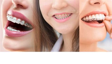 จัดฟันมีกี่แบบ แบบไหนเหมาะกับคุณ เลือกอย่างไร | COSDENT by SLC