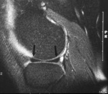Meniscal Tears On MRI Practice Essentials Anatomy Descriptions And Classifications