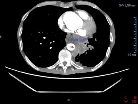 Contrast Enhanced Ct Scan Large Lesion Suggestive Of Lung Cancer