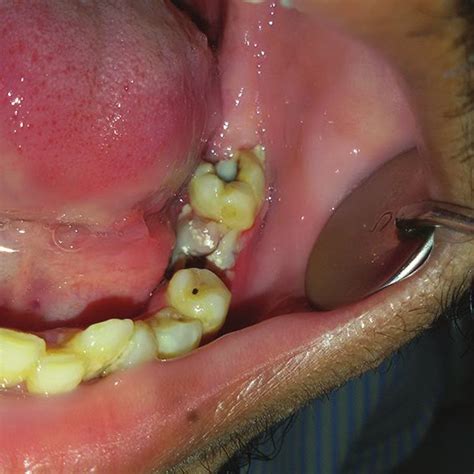 PDF Alveolar Osteitis In A Patient With Common Variable