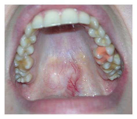 Pleomorphic Adenoma Of The Junction Between The Soft And Hard Palate