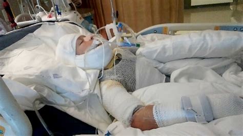 10 Year Old Kerrville Boy In A Coma After Suffering Severe Burns San