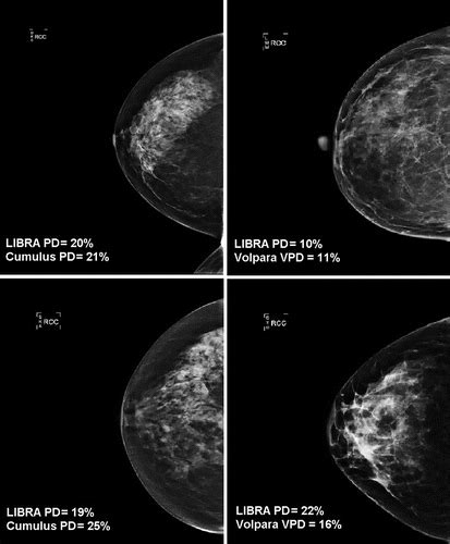 Evaluation Of Libra Software For Fully Automated Mammographic Density