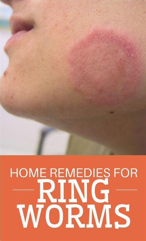 Healing Home Remedies For Ringworm The Homestead Survival
