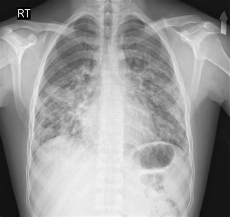 Eosinophilic Pneumonia Chest X Ray Wikidoc