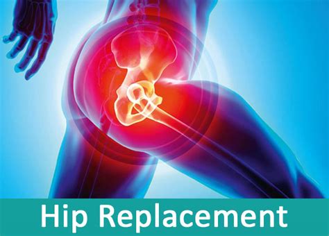 Hip Replacement Surgery And A Brief Overview Of Doing It