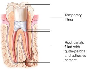 What to expect before, during and after a root canal? ROOT CANAL TREATMENT ⋆ Gary Riddle, D.D.S.