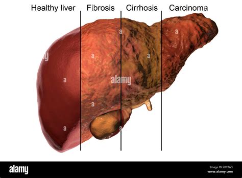 Hígado humano mostrando las etapas de la enfermedad hepática equipo de ilustración Fotografía