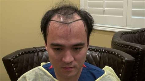 How important is men's hair for asian women? Balding Hair Loss Asian Patient Hair Restoration Procedure ...