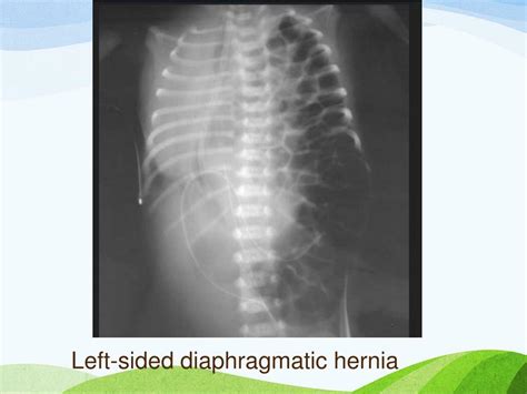 Ppt Diaphragmatic Hernia Powerpoint Presentation Free Download Id